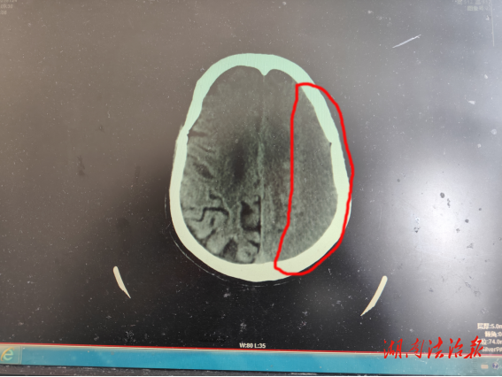 常寧市人民醫(yī)院：拒絕“腦洞”大開 微創(chuàng)技術(shù)治愈被忽略的“腦出血”