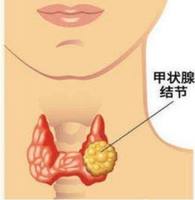 【科普】让人纠结的甲状腺结节，到底切？还是不切？