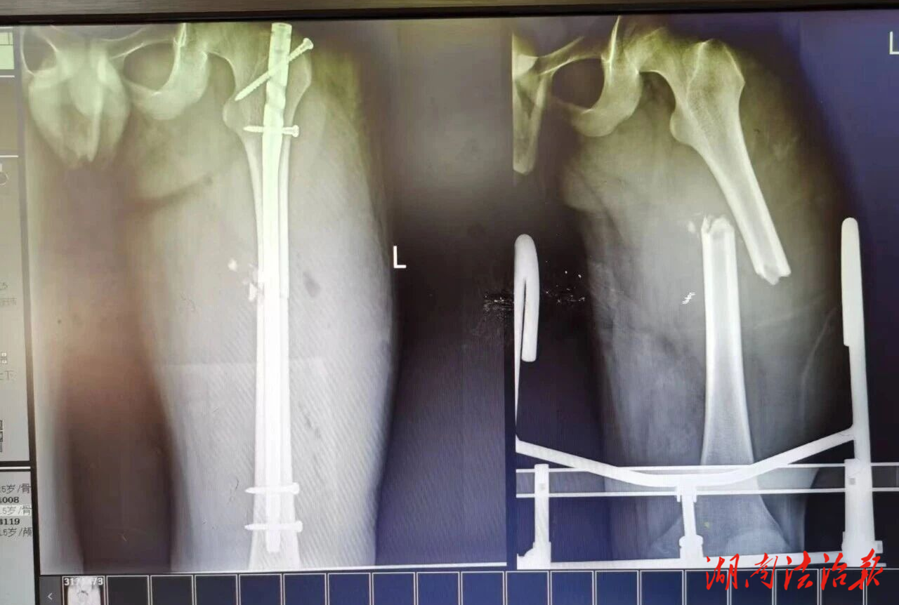 不碰生長線，巧固骨折處！江永縣人民醫(yī)院微創(chuàng)髓內(nèi)釘術(shù)為青少年骨骼成長上“保險(xiǎn)”