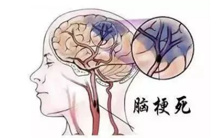 邵阳市中心医院：欢乐春节，防“梗”先行：脑梗防治要点速览