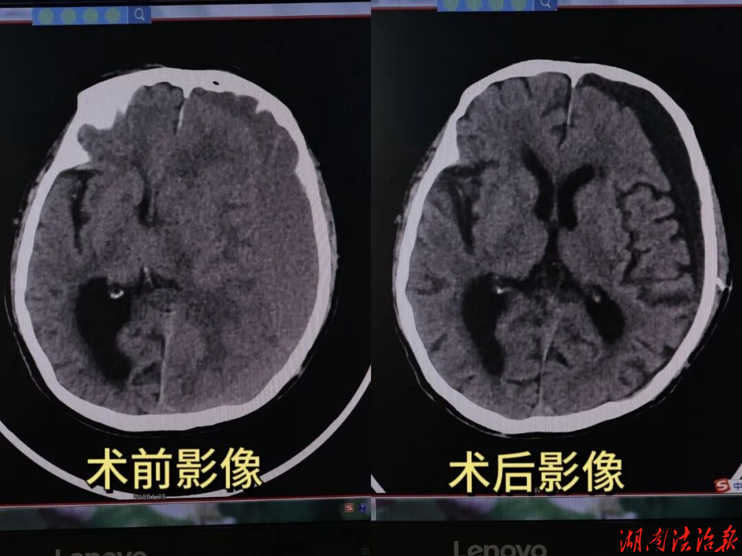 八旬老人突发脑疝危及性命，新田县中医医院巧排血肿化险为夷