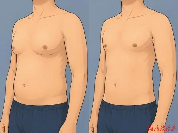 认识男性乳房发育：正视男性胸部异常增生——邵阳市中心医院乳甲外科开展多例男性乳房发育矫治手术
