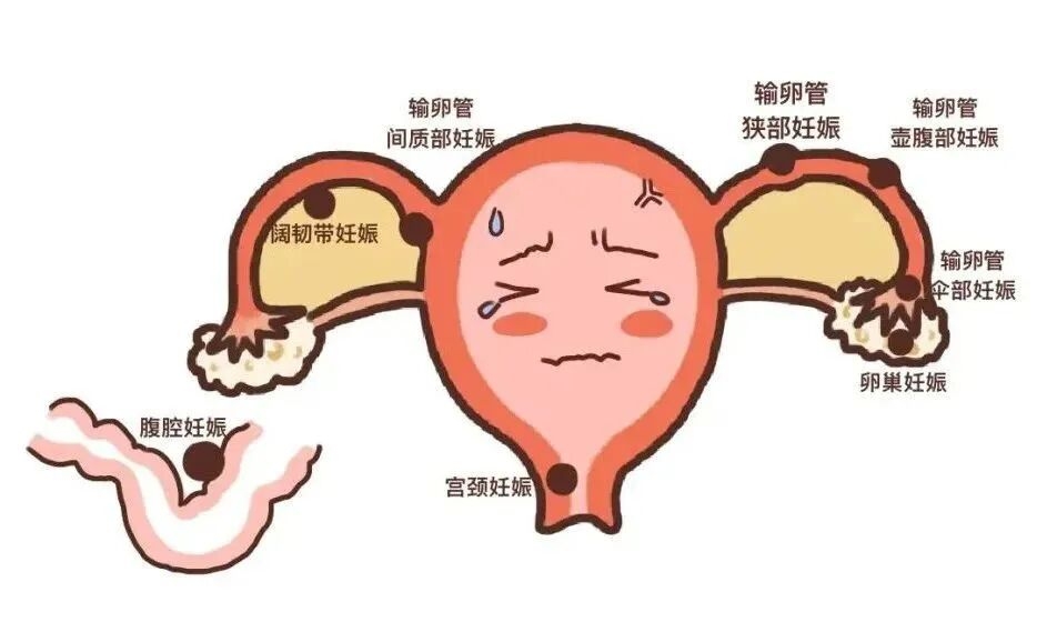 邵医科普：女性全生命周期管理丨“迷路”的种子：异位妊娠，一场需要和时间赛跑的“险情”