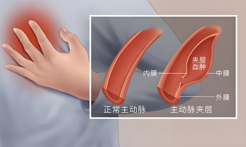 多学科协同救治高危大血管疾病患者 市中心医院心胸外科开展复杂大血管急诊手术